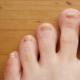 Болезни ногтей: разновидности, лечение и профилактика