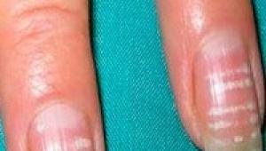 Белые пятна на ногтях – причины и лечение, народные средства