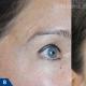 Мезороллер для лица: отзывы врачей косметологов