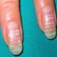 Белые пятна на ногтях – причины и лечение, народные средства